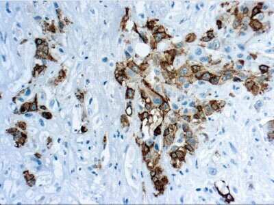 Immunohistochemistry-Paraffin: Mesothelin Antibody (YP158) [NBP2-75255] - Formalin fixed paraffin embedded human mesothelioma stained with Mesothelin antibody (NBP2-75255)