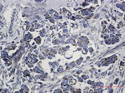 Immunohistochemistry-Paraffin: Methylmalonyl Coenzyme A mutase Antibody (S05-3G4) [NBP3-19689] - Immunohistochemistry of Methylmalonyl Coenzyme A mutase in paraffin-embedded Human Cholangiocarcinoma using NBP3-19689 at dilution 1/50