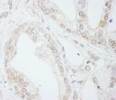 Immunohistochemistry-Paraffin: Methyltransferase like 3 Antibody [NB100-77311] - Sample: FFPE section of human prostate carcinoma. Antibody: Affinity purified rabbit anti- METTL3/MT-A70 used at a dilution of 1:1,000 (1 ug/ml). Detection: DAB