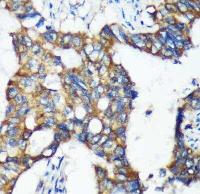 Immunohistochemistry-Paraffin: Mic1 Antibody [NBP3-03433] - Human colon carcinoma using Mic1  Rabbit pAb at dilution of 1:100 (40x lens).