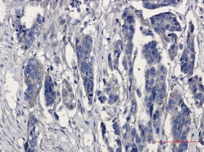 Immunohistochemistry-Paraffin: Microsomal Glutathione S-transferase 1 Antibody (S06-1E9) [NBP3-19501] - Immunohistochemistry of Microsomal Glutathione S-transferase 1 in paraffin-embedded Human Cholangiocarcinoma using NBP3-19501 at dilution 1/20