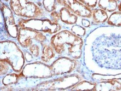 Immunohistochemistry-Paraffin: Mitochondria Antibody (113-1) - Azide and BSA Free [NBP2-34517] - Formalin-fixed paraffin-embedded human Renal cell carcinoma stained with Mitchondria Monoclonal antibody (113-1).