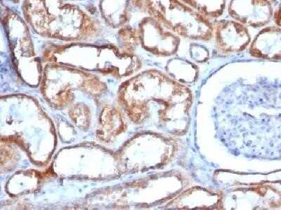 Immunohistochemistry-Paraffin: Mitochondria Antibody (113-1) - IHC-Prediluted [NBP2-45195] - Formalin-fixed paraffin-embedded human Renal cell carcinoma stained with Mitochondria Monoclonal antibody (113-1). Image using the Azide and BSA Free form of this antibody.