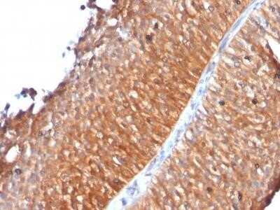 Immunohistochemistry-Paraffin: Mitochondria Antibody (MTC719) - Azide and BSA Free [NBP2-34687] - Formalin-fixed, paraffin-embedded human Bladder Carcinoma stained with Mitochondria Monoclonal Antibody (MTC719).