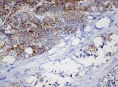 Immunohistochemistry: Mitochondrial ribosomal protein L11 Antibody (1E5) [NBP2-45836] - Analysis of Adenocarcinoma of Human colon tissue. (Heat-induced epitope retrieval by 10mM citric buffer, pH6.0, 120C for 3min)