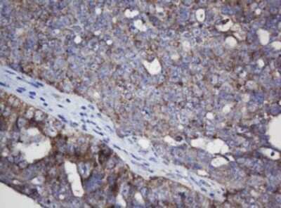 Immunohistochemistry: Mitochondrial ribosomal protein L11 Antibody (1E5) [NBP2-45836] - Analysis of Adenocarcinoma of Human ovary tissue. (Heat-induced epitope retrieval by 10mM citric buffer, pH6.0, 120C for 3min)