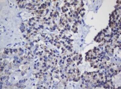 Immunohistochemistry: Mitochondrial ribosomal protein L11 Antibody (1E5) [NBP2-45836] - Analysis of Carcinoma of Human pancreas tissue. (Heat-induced epitope retrieval by 10mM citric buffer, pH6.0, 120C for 3min)