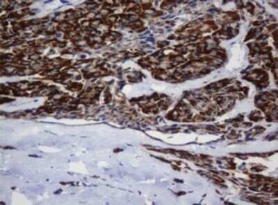 Immunohistochemistry: Mitochondrial ribosomal protein L11 Antibody (1E5) [NBP2-45836] - Analysis of Carcinoma of Human thyroid tissue. (Heat-induced epitope retrieval by 10mM citric buffer, pH6.0, 120C for 3min)