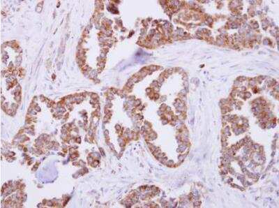 Immunohistochemistry-Paraffin: Mitochondrial ribosomal protein L11 Antibody [NBP2-17296] - Paraffin-embedded lung carcinoma. MRPL11 antibody [N1C3] dilution: 1:250.
