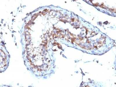 Immunohistochemistry-Paraffin: Moesin Antibody (MSN/492) - Azide and BSA Free [NBP2-47916] - Human Testicular Carcinoma stained with Moesin Monoclonal Antibody (MSN/492)