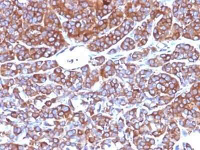 Immunohistochemistry-Paraffin: Moesin Antibody (MSN/492) - Azide and BSA Free [NBP2-47916] - Human Melanoma stained with Moesin Monoclonal Antibody (MSN/492)