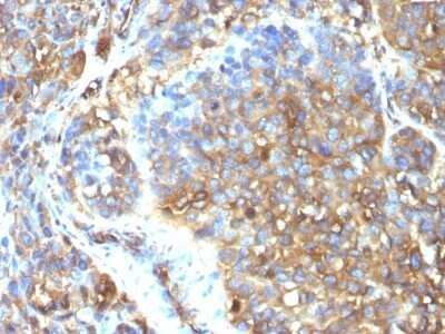 Immunohistochemistry-Paraffin: Moesin Antibody (MSN/493) - Azide and BSA Free [NBP2-47917] - Human Melanoma stained with Moesin Monoclonal Antibody (MSN/493)