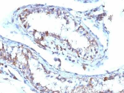 Immunohistochemistry-Paraffin: Moesin Antibody (MSN/493) - Azide and BSA Free [NBP2-47917] - Human Testicular Carcinoma stained with Moesin Monoclonal Antibody (MSN/493)