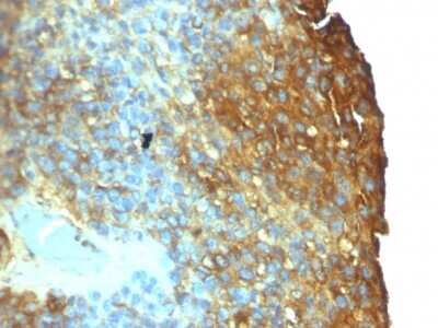 Immunohistochemistry-Paraffin: Moesin Antibody (SPM562) - Azide and BSA Free [NBP2-34798] - Formalin-fixed, paraffin-embedded human Melanoma stained with Moesin Antibody (SPM562)