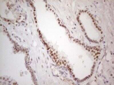 Immunohistochemistry: Mohawk homeobox Antibody (OTI6B12) - Azide and BSA Free [NBP2-72758] - Analysis of Carcinoma of Human prostate tissue. (Heat-induced epitope retrieval by 1mM EDTA in 10mM Tris buffer (pH8.5) at 120C for 3 min)
