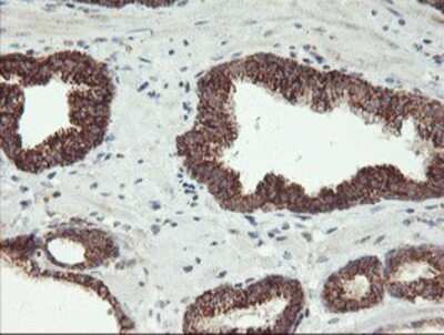 Immunohistochemistry-Paraffin: Monoamine Oxidase A Antibody (1D6) [NBP2-01751] - Staining of paraffin-embedded Carcinoma of Human prostate tissue using anti-Monoamine Oxidase A mouse monoclonal antibody.