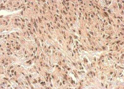 Immunohistochemistry-Paraffin: Monoglyceride Lipase Antibody [NBP2-19380] -  U373 xenograft. Monoglyceride lipase antibody dilution: 1:500. Antigen Retrieval: Trilogy™ (EDTA based, pH 8.0) buffer, 15min. 