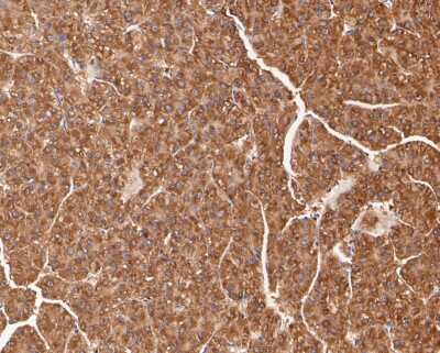 Immunohistochemistry-Paraffin: Mucolipin 3 Antibody [NBP2-80438] - Analysis in human liver carcinoma tissue using Mucolipin 3 antibody. The section was pre-treated using heat mediated antigen retrieval with sodium citrate buffer (pH 6.0) for 20 minutes. The tissues were blocked in 5% BSA for 30 minutes at room temperatur