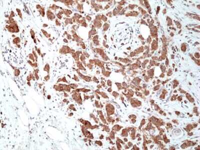 Immunohistochemistry-Paraffin: Musashi-2 Antibody (RM422) [NBP3-09175] - Immunohistochemical staining of formalin fixed and paraffin embedded human breast ductal carcinoma tissue section using NBP3-09175 at a 1:400 dilution.