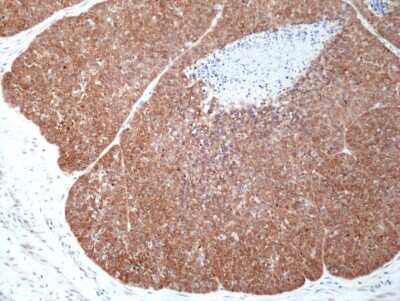 Immunohistochemistry-Paraffin: Musashi-2 Antibody (RM422) [NBP3-09175] - Immunohistochemical staining of formalin fixed and paraffin embedded human esophageal squamous carcinoma tissue section using NBP3-09175 at a 1:100 dilution.