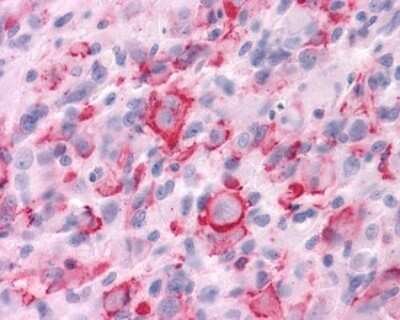 Immunohistochemistry-Paraffin: Muscarinic Acetylcholine Receptor M3/CHRM3 Antibody [NLS5259] - Analysis of anti-CHRM3 / M3 antibody with human brain, glioblastoma.