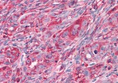 Immunohistochemistry-Paraffin: Muscarinic Acetylcholine Receptor M3/CHRM3 Antibody [NLS5259] - Human Ovary, Carcinoma formalin-fixed, paraffin-embedded tissue after heat-induced antigen retrieval.