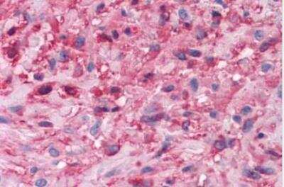 Immunohistochemistry-Paraffin: Muscarinic Acetylcholine Receptor M3/CHRM3 Antibody [NLS5259] - Brain, glioblastoma