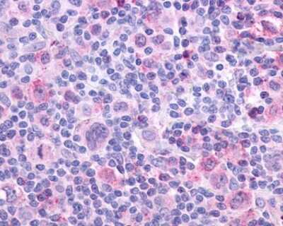 Immunohistochemistry-Paraffin: Muscarinic Acetylcholine Receptor M4/CHRM4 Antibody [NLS220] - Analysis of anti-CHRM4 / M4 antibody with human lymph node, Hodgkins lymphoma.