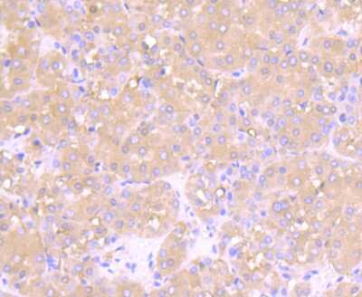 Immunohistochemistry-Paraffin: Muscle Phosphofructokinase/PFKM/PFK-1 Antibody (JU53-31) [NBP2-75578] - Analysis of paraffin-embedded human liver cancer tissue using anti-Fructose 6 Phosphate Kinase antibody. Counter stained with hematoxylin.