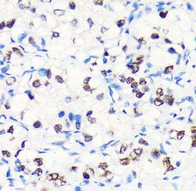 Immunohistochemistry-Paraffin: Myelin expression factor 2 Antibody [NBP2-93986] - Human liver cancer using MYEF2 Rabbit pAb at dilution of 1:100 (40x lens).