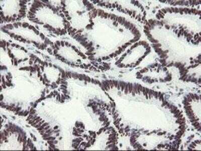 Immunohistochemistry: Myeloid leukemia factor 1 Antibody (OTI3A3) - Azide and BSA Free [NBP2-72846] - Staining of paraffin-embedded Adenocarcinoma of Human colon tissue using anti-Myeloid leukemia factor 1 mouse monoclonal antibody.