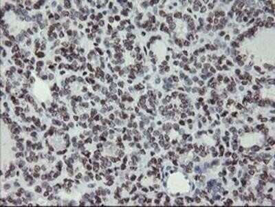 Immunohistochemistry: Myeloid leukemia factor 1 Antibody (OTI3A3) - Azide and BSA Free [NBP2-72846] - Staining of paraffin-embedded Carcinoma of Human thyroid tissue using anti-Myeloid leukemia factor 1 mouse monoclonal antibody.