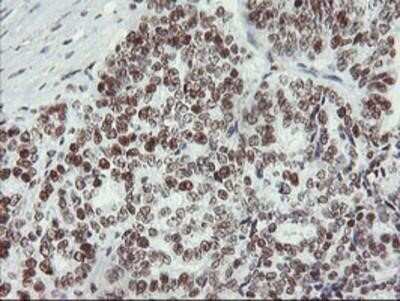 Immunohistochemistry-Paraffin: Myeloid leukemia factor 1 Antibody (OTI3A3) [NBP2-02052] - Staining of paraffin-embedded Adenocarcinoma of Human ovary tissue using anti-Myeloid leukemia factor 1 mouse monoclonal antibody.
