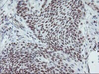 Immunohistochemistry-Paraffin: Myeloid leukemia factor 1 Antibody (OTI3A3) [NBP2-02052] - Staining of paraffin-embedded Carcinoma of Human bladder tissue using anti-Myeloid leukemia factor 1 mouse monoclonal antibody.