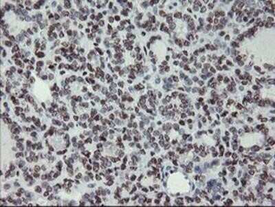 Immunohistochemistry-Paraffin: Myeloid leukemia factor 1 Antibody (OTI3A3) [NBP2-02052] - Staining of paraffin-embedded Carcinoma of Human thyroid tissue using anti-Myeloid leukemia factor 1 mouse monoclonal antibody.