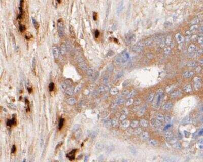 Immunohistochemistry-Paraffin: Myeloperoxidase/MPO Antibody (A1F2) [NBP2-89126] - Analysis of paraffin-embedded human colon carcinoma tissue using anti-Myeloperoxidase antibody. The section was pre-treated using heat mediated antigen retrieval with Tris-EDTA buffer (pH 8.0-8.4) for 20 minutes.The tissues were blocked in 5% BSA for 30 minutes at room temperature, washed with ddH2O and PBS, and then probed with the primary antibody( 1/50) for 30 minutes at room temperature. The detection was performed using an HRP conjugated compact polymer system. DAB was used as the chromogen. Tissues were counterstained with hematoxylin and mounted with DPX.
