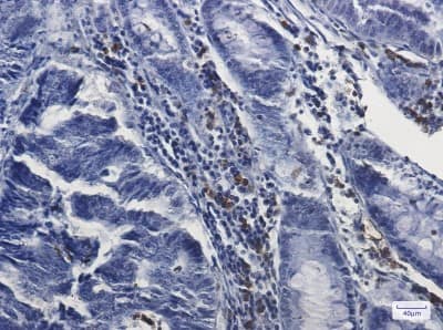 Immunohistochemistry-Paraffin: Myeloperoxidase/MPO Antibody (S07-2C7) [NBP3-19707] - Immunohistochemistry of Myeloperoxidase/MPO in paraffin-embedded Human colon cancer tissue using NBP3-19707 at dilution 1/50