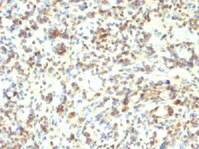 Immunohistochemistry-Paraffin: MyoD Antibody (5.8A + MYD712) [NBP2-34277] - Formalin-fixed, paraffin-embedded human Rhabdomyosarcoma stained with MyoD1 Monoclonal Antibody (5.8A+ MYD712)