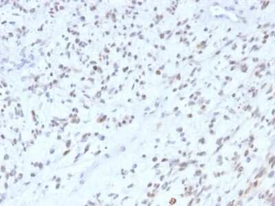 Immunohistochemistry-Paraffin: MyoD Antibody (MYOD1/2075R) - Azide and BSA Free [NBP2-75772] - Formalin-fixed, paraffin-embedded human rhabdomyosarcoma stained with MyoD Recombinant Rabbit Monoclonal Antibody (MYOD1/2075R).