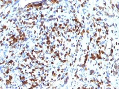 Immunohistochemistry-Paraffin: MyoD Antibody (MYOD1/2075R) - Azide and BSA Free [NBP2-75772] - Formalin-fixed, paraffin-embedded human rhabdomyosarcoma stained with MyoD Recombinant Rabbit Monoclonal Antibody (MYOD1/2075R).
