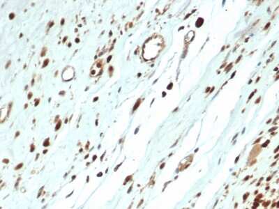 Immunohistochemistry-Paraffin: MyoD Antibody (MYOD1/3418R) - Azide and BSA Free [NBP3-08543] - Formalin-fixed, paraffin-embedded human rhabdomyosarcoma stained with MyoD Recombinant Rabbit Monoclonal Antibody (MYOD1/3418R). HIER: Tris/EDTA pH9.0; 95C/45min. 1 Ab: 2ug/ml in PBS:30min. 2 Ab: HRP-Poly:30min. DAB:5min.