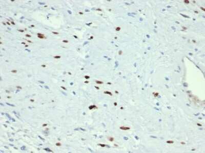 Immunohistochemistry-Paraffin: MyoD Antibody (MYOD1/3418R) [NBP3-07404] - Formalin-fixed, paraffin-embedded human rhabdomyosarcoma stained with MyoD Recombinant Rabbit Monoclonal Antibody (MYOD1/3418R). HIER: Tris/EDTA pH9.0; 95C/45min. 1 Ab: 2ug/ml in PBS:30min. 2 Ab: HRP-Poly:30min. DAB:5min