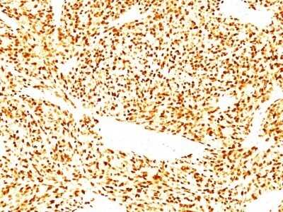 Immunohistochemistry-Paraffin: MyoD Antibody (SPM427) - IHC-Prediluted [NBP2-44677] - Formalin-fixed, paraffin-embedded human Rhabdomyosarcoma stained with MyoD Antibody (SPM427).