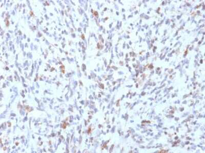 Immunohistochemistry-Paraffin: MyoD Antibody (rMYD712) [NBP3-08505] - Formalin-fixed, paraffin-embedded human Rhabdomyosarcoma stained with MyoD Mouse Recombinant Monoclonal Antibody (rMYD712).