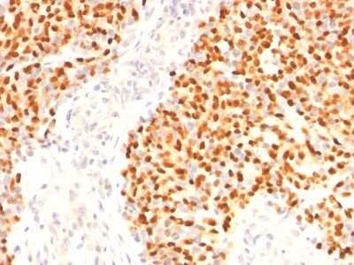 Immunohistochemistry-Paraffin: Myogenin Antibody (F5D) - Azide and BSA Free [NBP2-34616] - Formalin-fixed, paraffin-embedded human rhabdomyosarcoma stained with Myogenin MAb (F5D)