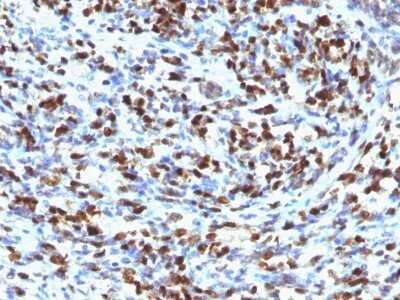Immunohistochemistry-Paraffin: Myogenin Antibody (MGN185) - IHC-Prediluted [NBP2-44327] - Formalin-fixed, paraffin-embedded human Rhabdomyosarcoma stained with MyoD Antibody (MYOD1/2075R).