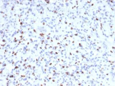 Immunohistochemistry-Paraffin: Myogenin Antibody (MYOG/2660) [NBP3-08544] - Formalin-fixed, paraffin-embedded human Rhabdomyosarcoma stained with Myogenin Mouse Monoclonal Antibody (MYOG/2660)