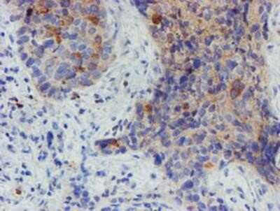 Immunohistochemistry: Myoneurin Antibody (OTI1F10) - Azide and BSA Free [NBP2-72863] - Staining of paraffin-embedded Carcinoma of Human lung tissue using anti-Myoneurin mouse monoclonal antibody.
