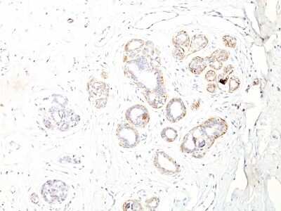 Immunohistochemistry-Paraffin: Myosin heavy chain 11 Antibody (ID8) [NBP2-44532] - Human Breast Carcinoma stained with SM-MHC Monoclonal Antibody (ID8).