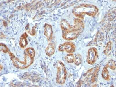 Immunohistochemistry-Paraffin: Myosin heavy chain 11 Antibody (ID8) [NBP2-44532] - Human Leiomyosarcoma stained with SM-MHC Monoclonal Antibody (ID8).